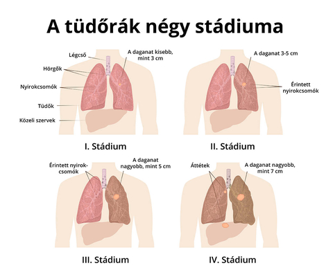 Onkofertilitás és kezelési lehetőségei